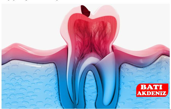Diş Çürüğü Nasıl Başlar