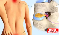 Nükleoplasti Hakkında Her Şey ve Op. Dr. Murat Karakuş ile Tanışın