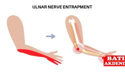 Ulnar Sinir Sıkışması: Eldeki Uyuşmanın Arkasındaki Görünmeyen Sebep
