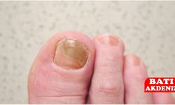 Tırnak Mantarı Belirtileri Nelerdir?
