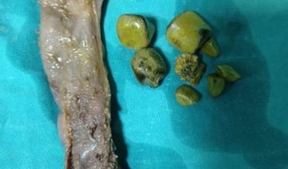 Dünyanın en büyük safra kesesi ameliyatı Kumluca'da yapıldı