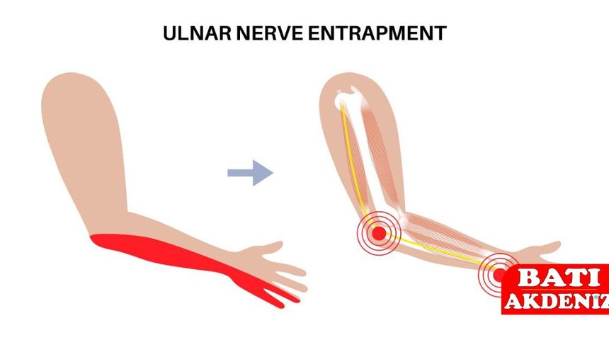 Ulnar Sinir Sıkışması: Eldeki Uyuşmanın Arkasındaki Görünmeyen Sebep