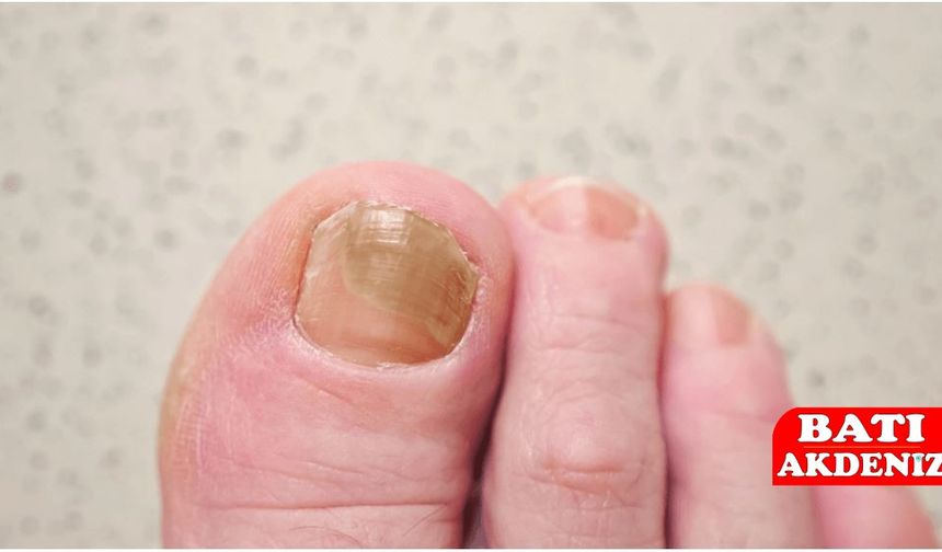Tırnak Mantarı Belirtileri Nelerdir?